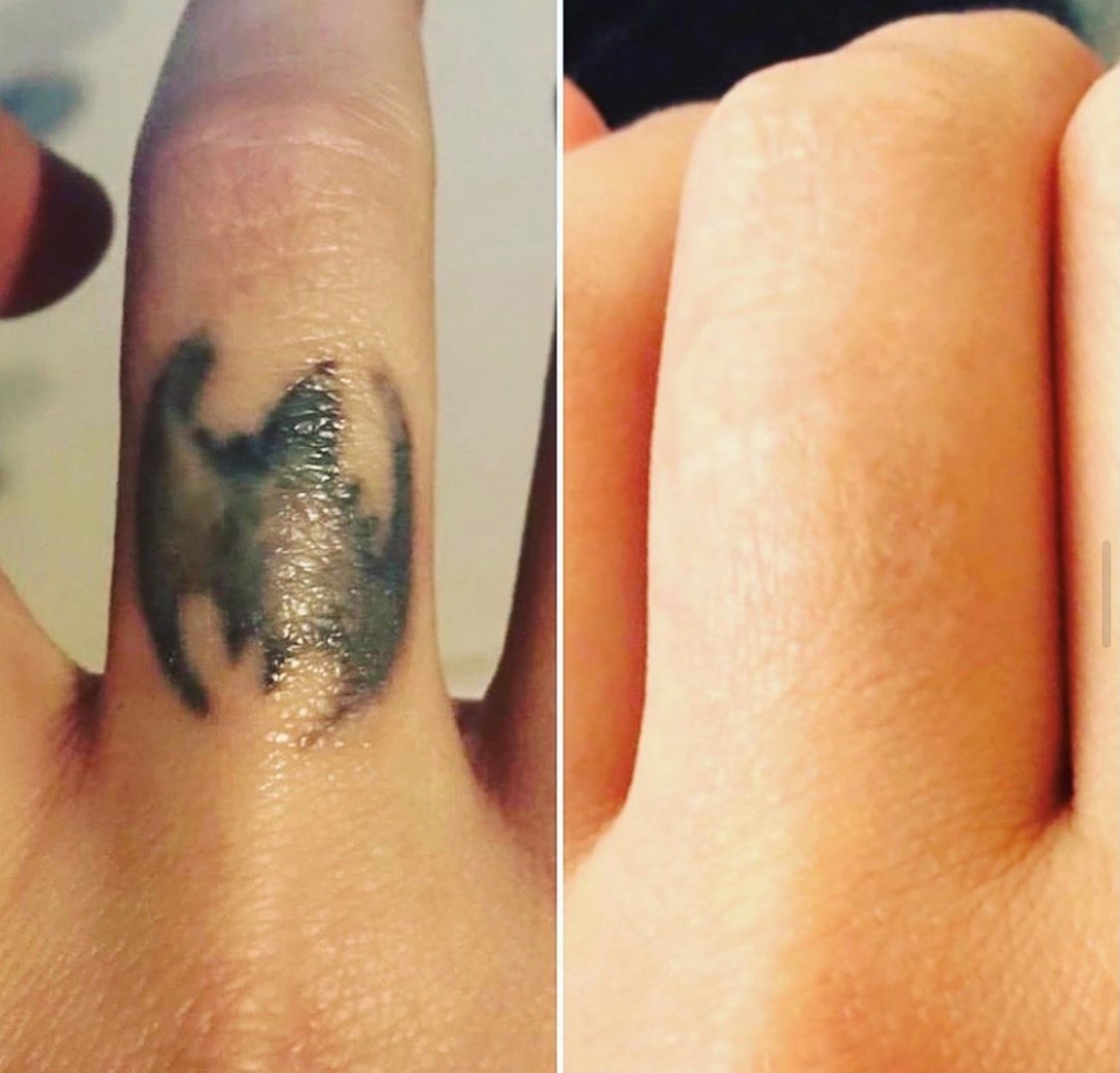 Voor en na tatoeage verwijderen